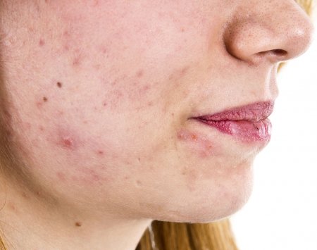 Woman with light acne