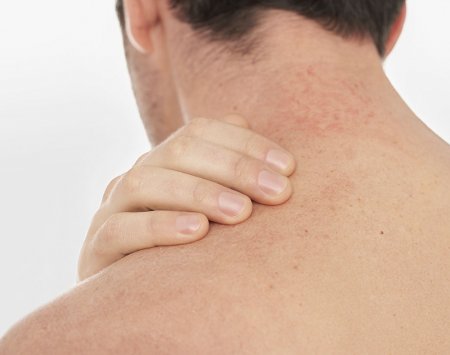 Atopic dermatitis on the back