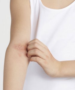Atopic dermatitis in adults